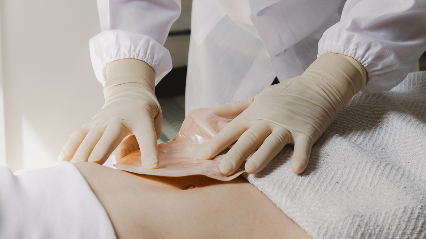 A woman is fitted with a stoma pouch